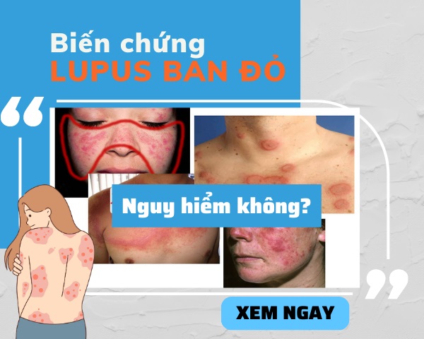 Bi N Ch Ng Lupus Ban Nguy Hi M Kh Ng C I Thi N Ra Sao