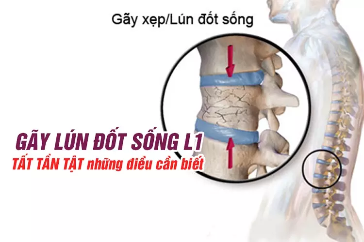 Gay-lun-dot-song-L1-TAT-TAN-TAT-nhung-dieu-can-biet.webp