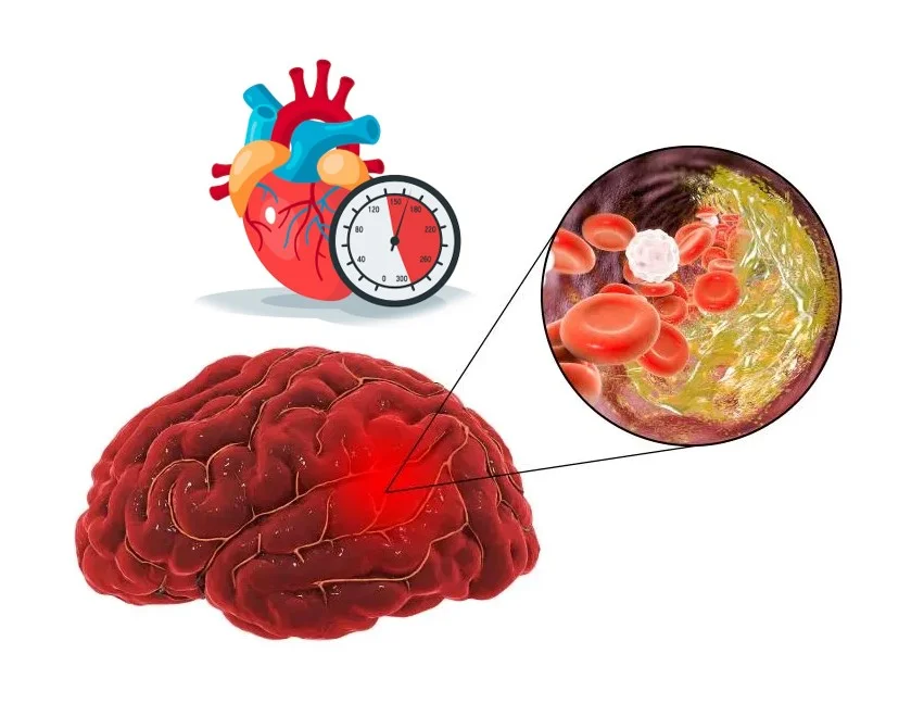 Lý giải tại sao tăng huyết áp gây nhồi máu não?
