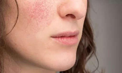 Tần tần tật về chàm da mặt mà bạn cần biết
