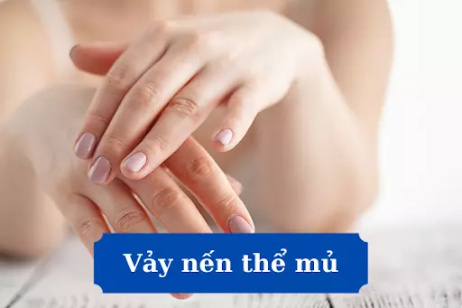 Vảy nến thể mủ - Những nguy hiểm có thể bạn chưa biết