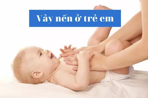 Bệnh vảy nến ở trẻ em - Những điều cha mẹ cần biết