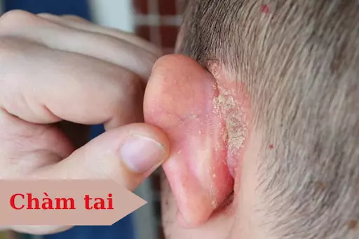 Bệnh chàm tai: Cách chữa trị dứt điểm và những thông tin quan trọng khác