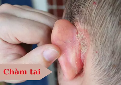 Bệnh chàm tai: Cách chữa trị dứt điểm và những thông tin quan trọng khác