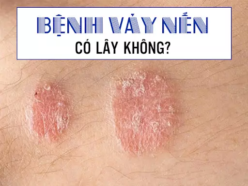 Bệnh vảy nến có lây không? Nguyên nhân và cách phòng ngừa