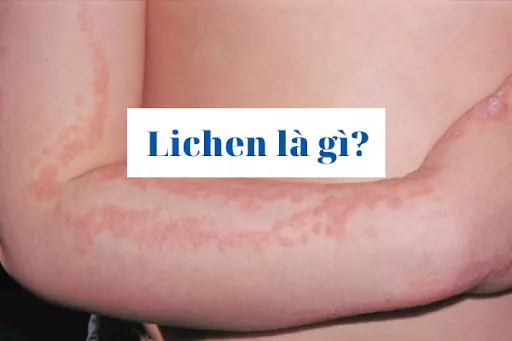 Lichen là gì? Tìm hiểu về bệnh và cách điều trị tại đây