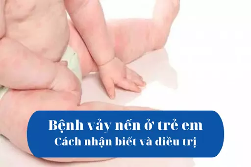 Bệnh vảy nến ở trẻ em - Cách nhận biết và điều trị