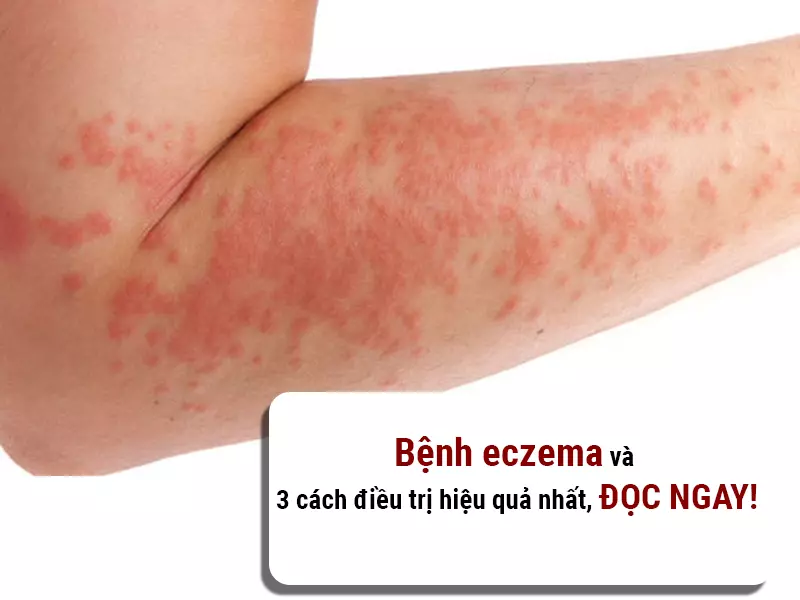 Bệnh eczema và 3 cách điều trị hiệu quả nhất, ĐỌC NGAY!