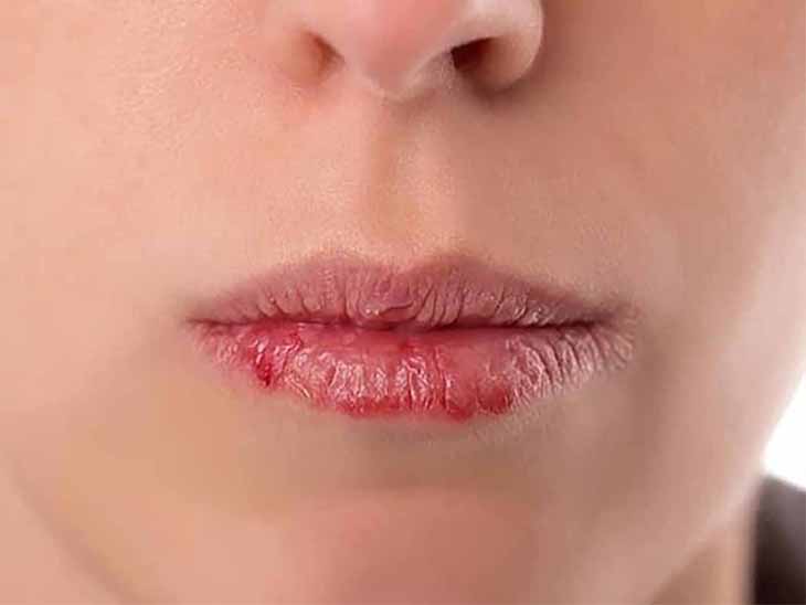 Chàm môi Triệu chứng nguyên nhân và cách trị bệnh chàm môi  Cẩm nang  bệnh da liễu