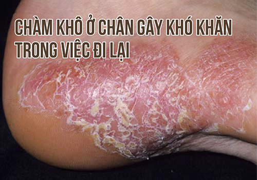 Bệnh Chàm Khô Ở Chân: Nguyên Nhân, Triệu Chứng và Cách Điều Trị