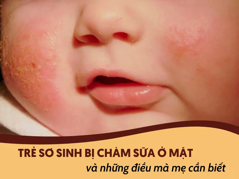 Trẻ sơ sinh bị chàm sữa ở mặt và những điều mà mẹ cần biết