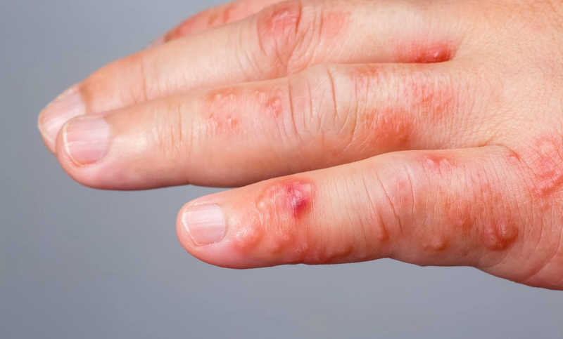 Ghẻ nước gây ngứa da dữ dội
