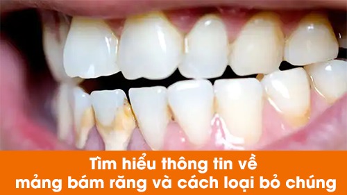 Tìm hiểu thông tin về mảng bám răng và cách loại bỏ chúng