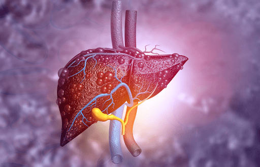 Điều trị gan nhiễm mỡ sớm để ngăn biến chứng xơ gan, ung thư gan
