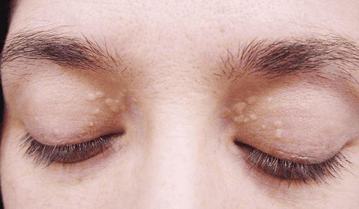 U vàng do mỡ máu cao gây ra nằm ở vị trí xung quanh mắt