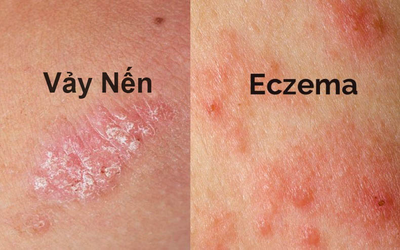 Phân biệt vẩy nến và eczema không khó