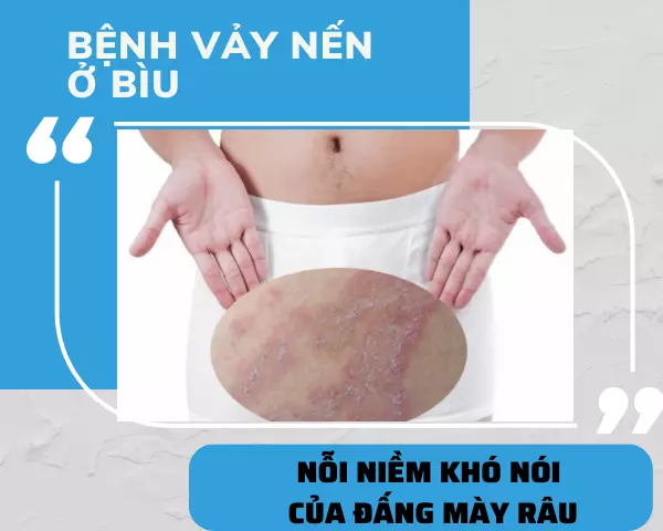 Bệnh vảy nến ở bìu: Nỗi niềm khó nói của đấng mày râu!