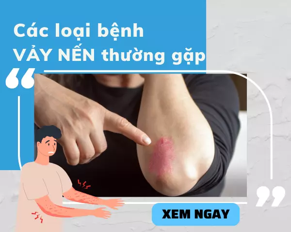 Vảy nến là gì? Điểm tên các loại bệnh vảy nến thường gặp