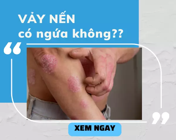 Giải đáp thắc mắc: Bị bệnh vảy nến có ngứa không? XEM NGAY!