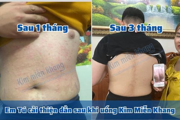 Các triệu chứng vảy nến trên da của em Tú mờ hẳn khi uống Kim Miễn Khang