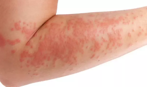 Triệu chứng của bệnh eczema