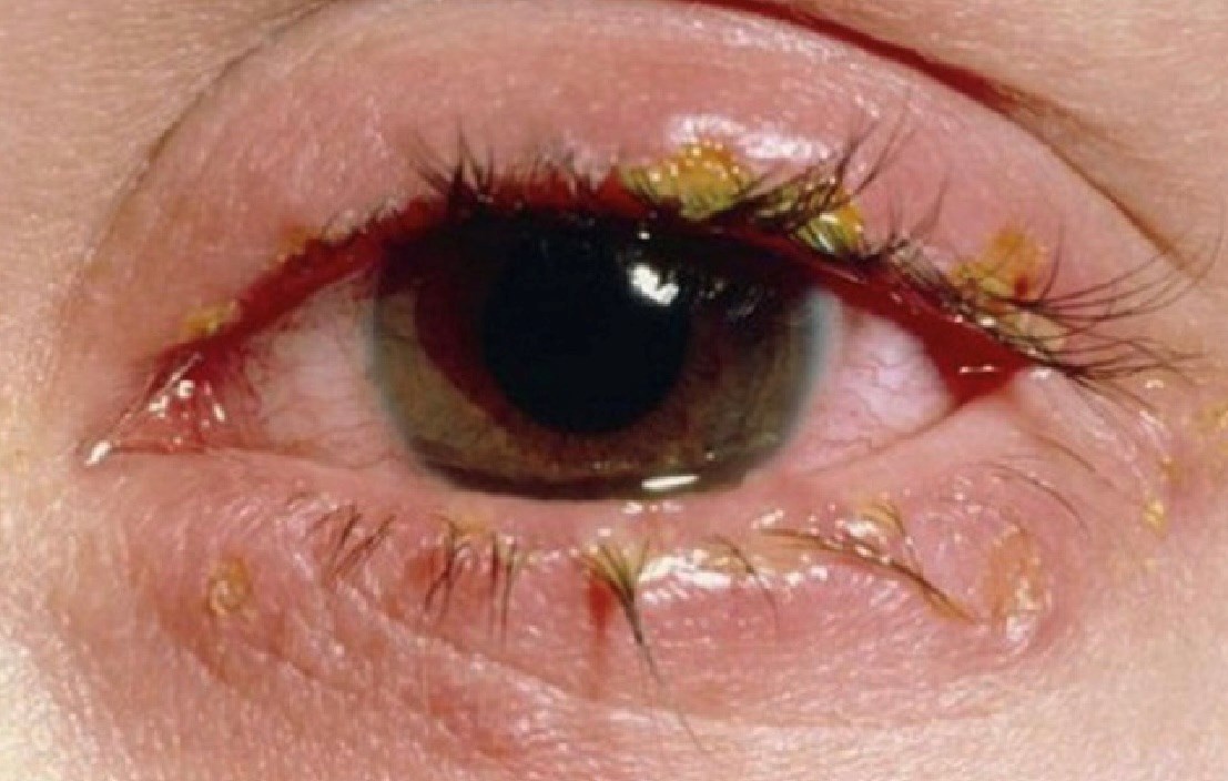 Đỏ mắt và ghèn ở mắt là triệu chứng phổ biến của đau mắt đỏ