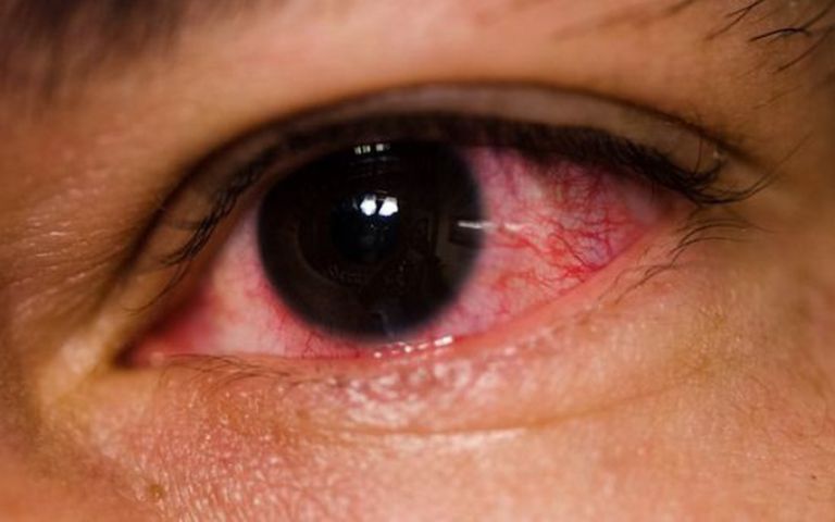 Đau mắt đỏ rất dễ lây lan thành dịch bệnh