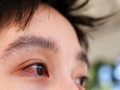 Bệnh đau mắt đỏ kiêng ăn gì?