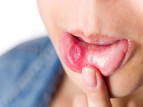 Hiểu về nhiệt miệng: Nguyên nhân, triệu chứng và cách điều trị