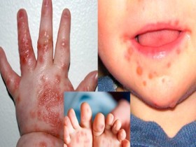 Chữa bệnh tay chân miệng cho trẻ hiệu quả bằng 4 loại tinh dầu tự nhiên