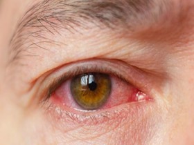 Các triệu chứng của đau mắt đỏ là gì? Chuyên gia giải đáp!