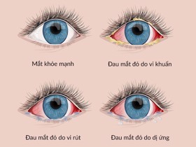 Tổng quan về bệnh đau mắt đỏ và những lưu ý cần biết