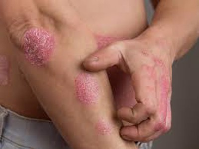 Ảnh hưởng của bệnh vẩy nến không chỉ dừng lại ở da