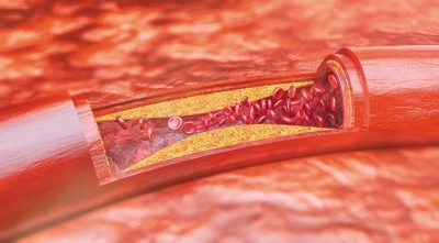 Rối loạn lipid máu ảnh hưởng NGHIÊM TRỌNG đến cơ thể ra sao?