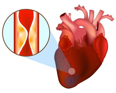 Nhồi máu cơ tim: Biến chứng nguy hiểm của xơ vữa động mạch do máu nhiễm mỡ