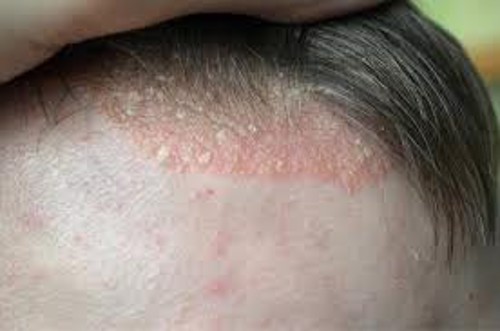 3% dân số bị mắc bệnh vảy nến da đầu
