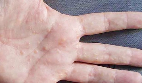 Viêm da, mụn nước ở bàn và ngón tay có phải tổ đỉa không?