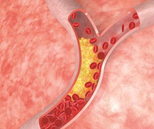 Rối loạn lipid máu có nguy hiểm không? Dùng sản phẩm thảo dược cải thiện có được không?