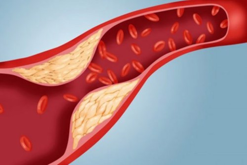 Mỡ máu cao - Kẻ âm thầm cướp đi "bản lĩnh" của đấng mày râu