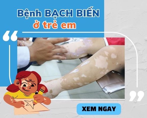 Những điều cần biết về bệnh bạch biến ở trẻ em - Xem ngay!